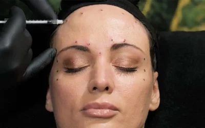 Botulinum Toxin