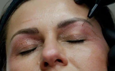 Plasma – Skin Tightening