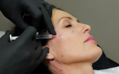 Profhilo Treatment